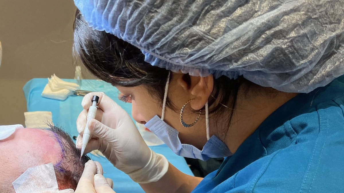 Implantace vlasových štěpů metodou DHI